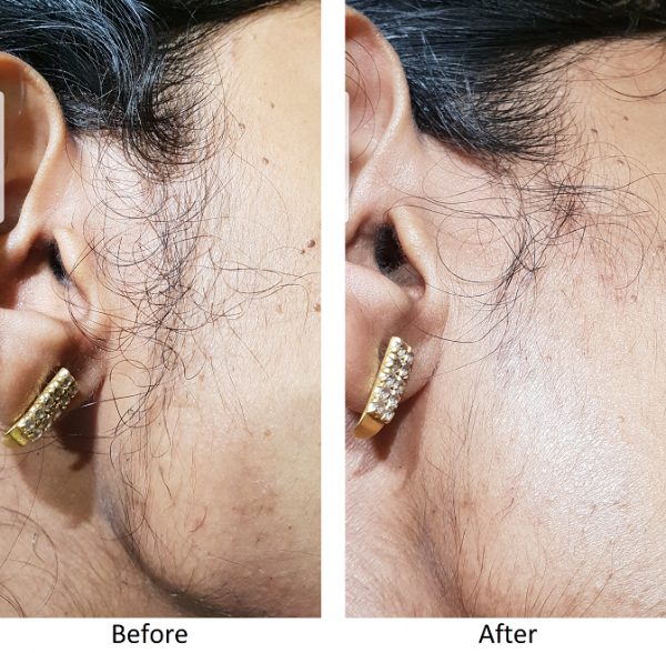 How Long Does It Take To Remove Hairs With Electrolysis? Advanced